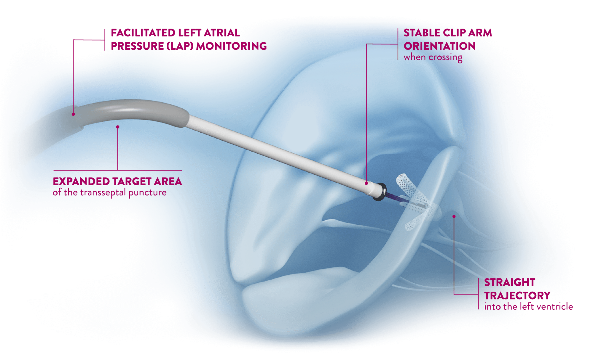 Clip Delivery System for Mitraclip via Steerable Guide Catheter