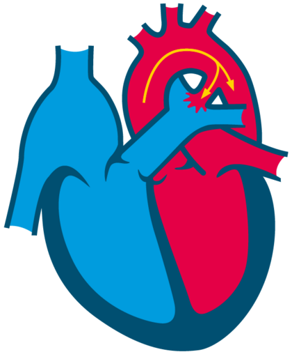 Patent ductus arteriosus