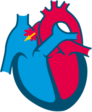 Symptoms of atrial septal defects