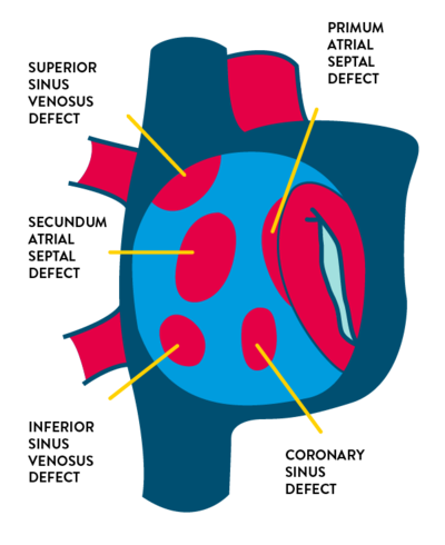 Types of atrial septal defects