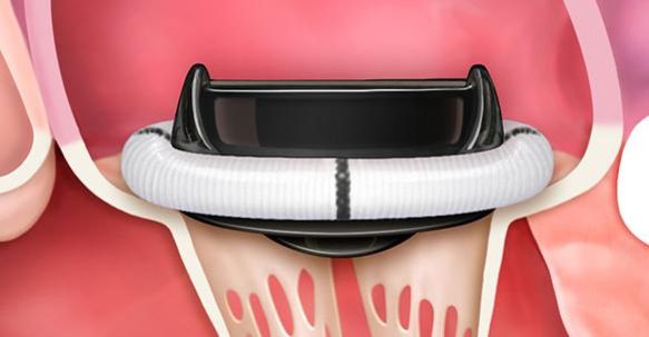 Mitral Regurgitation Treatment Patient Info