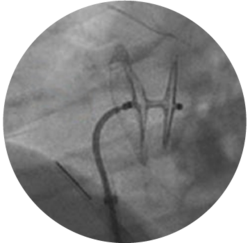 Amplatzer Talisman PFO Occluder is recapturable and repositionable for better PFO closure