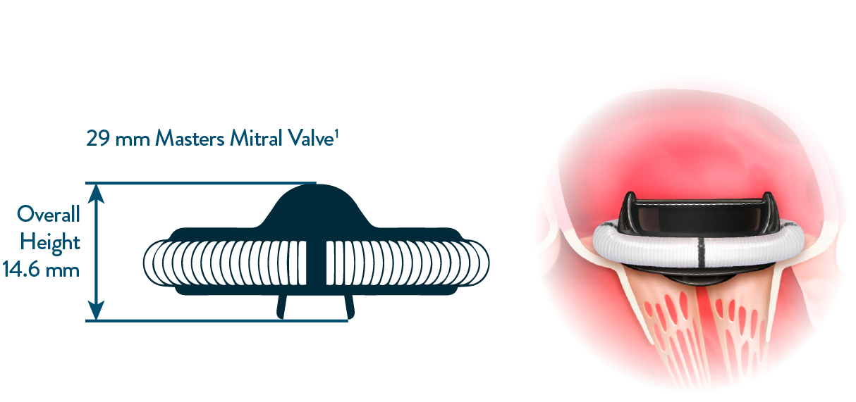 Abbott Masters mitral valve features low implant height Abbott Masters mitral valve features low implant height