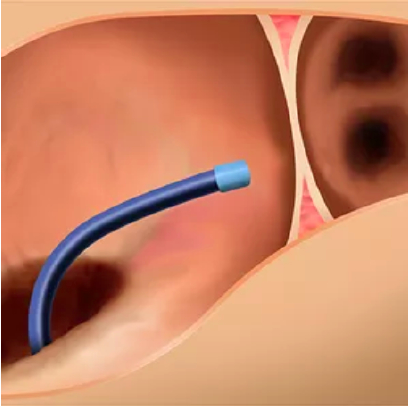 CATALYST trial: Amplatzer Amulet delivery system is introduced via femoral venous puncture CATALYST trial: Amplatzer Amulet delivery system is introduced via femoral venous puncture