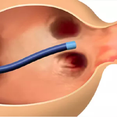 CATALYST trial: Amplatzer Amulet Occluder is delivered via transseptal puncture into the left atrium CATALYST trial: Amplatzer Amulet Occluder is delivered via transseptal puncture into the left atrium