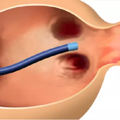 CATALYST trial: Amplatzer Amulet Occluder is delivered via transseptal puncture into the left atrium