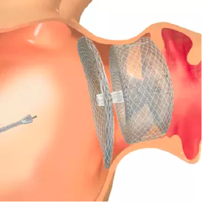 CATALYST trial: Amplatzer Amulet Occluder is guided to the left atrial appendage to treat non-valvular atrial fibrillation