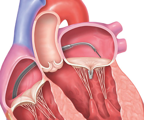 REPAIR MR clinical trial step 4