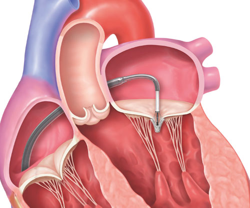 REPAIR MR clinical trial step 3