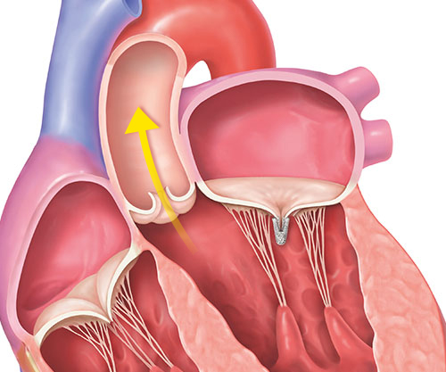 REPAIR MR clinical trial step 5