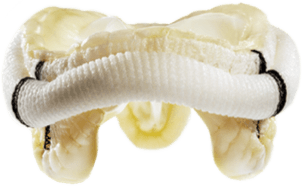 Epic™ Mitral Stented Tissue Valve