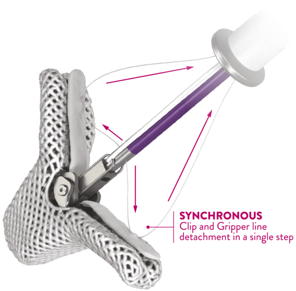 MitraClip simplified procedural steps