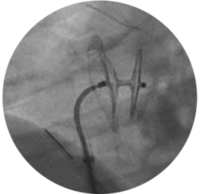 Amplatzer PFO Occluder is recapturable and repositionable for better PFO closure Amplatzer PFO Occluder is recapturable and repositionable for better PFO closure
