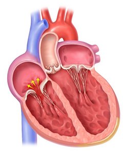 Tricuspid regurgitation (TR) is a condition in which the tricuspid valve does not close properly, causing blood to flow backward