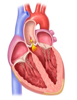 Aortic stenosis: a serious and progressive valve disease
