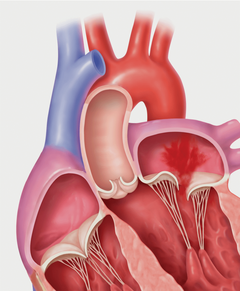 Primary MR, or degenerative MR, prolapse of the leaflets