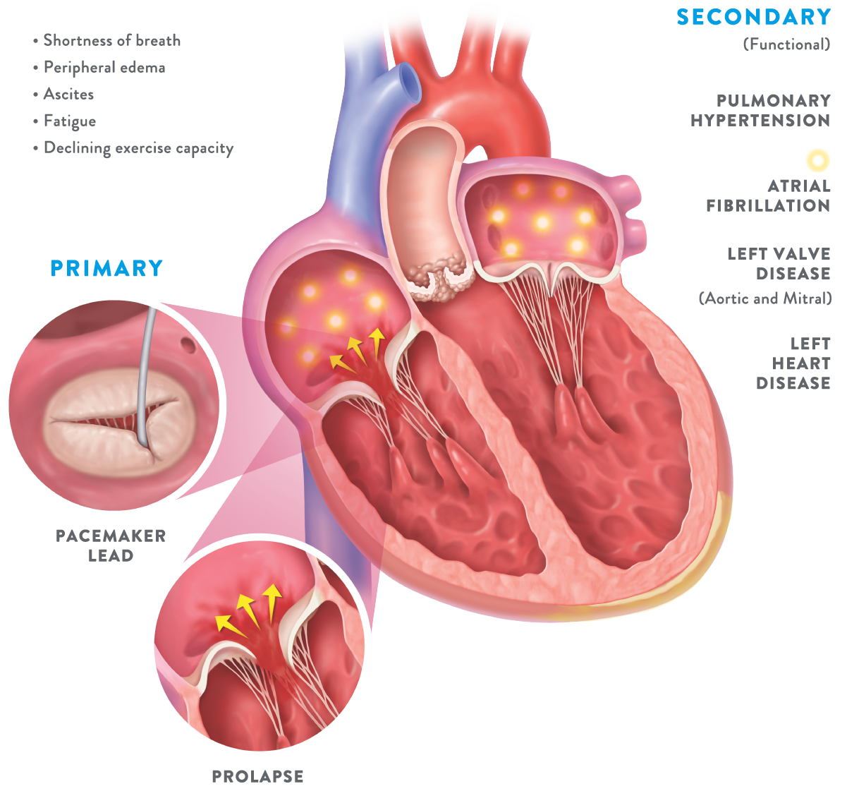 Patients with moderate or greater TR have significantly impaired quality of life