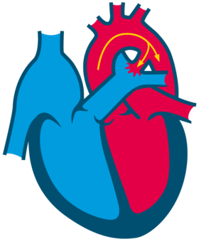 Patent ductus arteriosus 