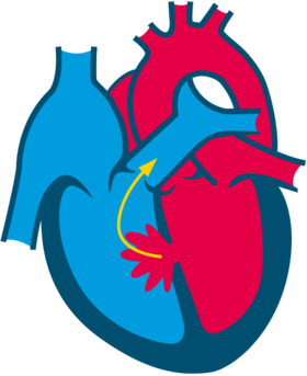 Ventricular septal defect