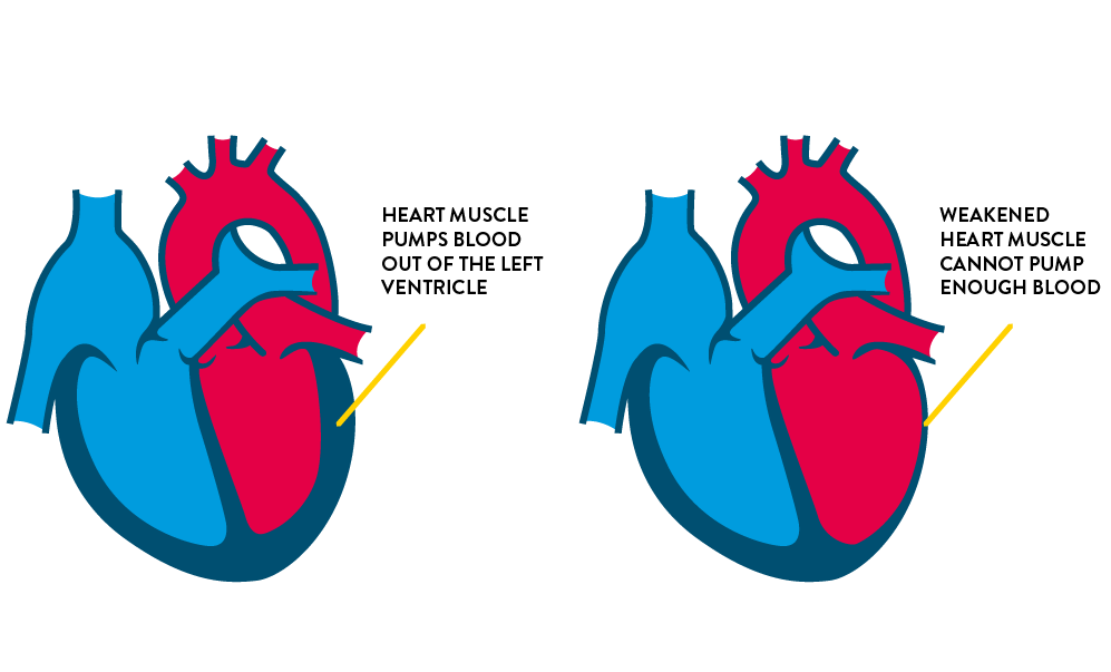 Symptoms of heart failure, weakened heart muscle