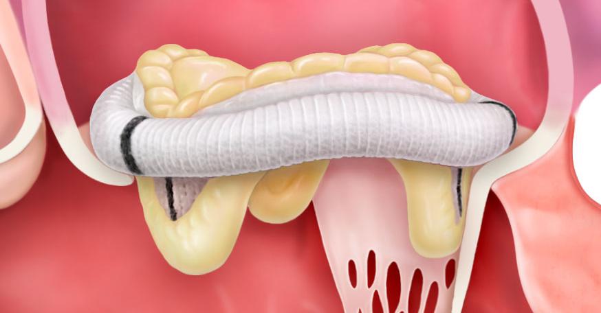 Tissue valves can last 10 to 15 years, requiring another surgery if it wears out, do not usually require blood-thinners 