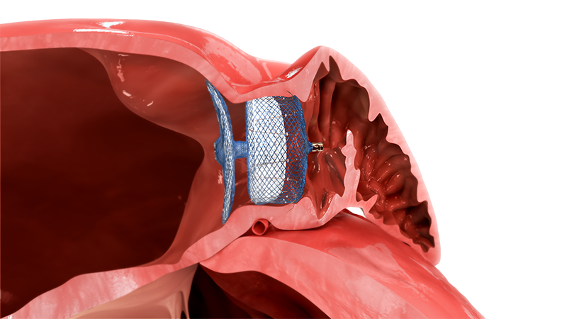 LAA Occluder