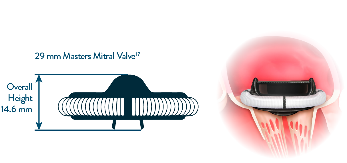 Abbott Masters mitral valve features low implant height
