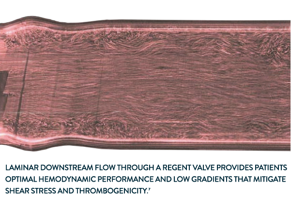 Abbott Regent valve provides laminar flow for optimal hemodynamic performance