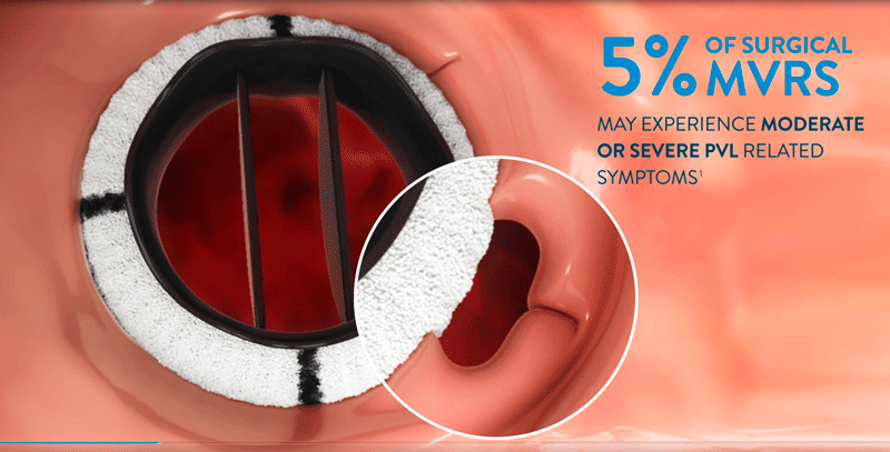 PARADIGM trial: PVL closure with the Amplatzer Valvular Plug occluder for interventional transcatheter closure