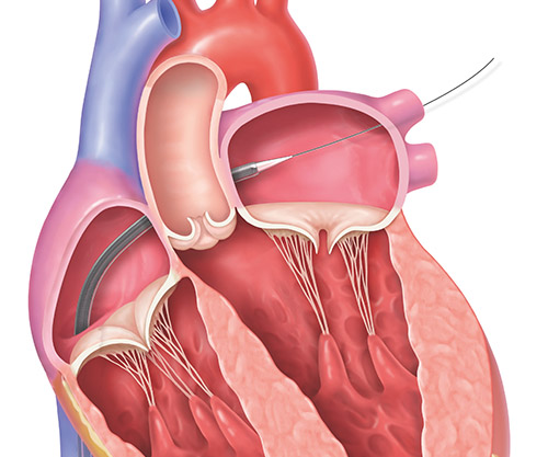 REPAIR MR clinical trial step 2