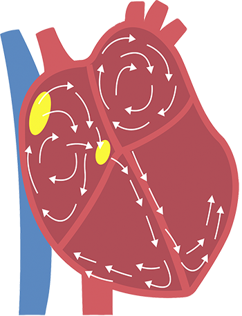 Atrial Fibrillation Atrial Fibrillation