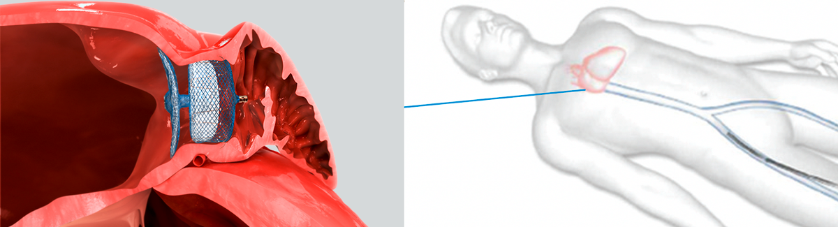 Amulet Left Atrial Appendage Occlusion