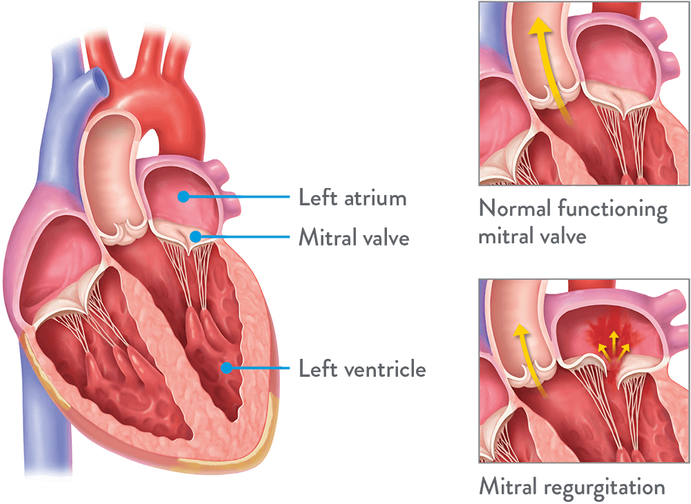 Mitral Regurgitation Mitral Regurgitation