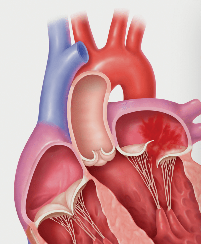 Primary Mitral Regrugitation Flail