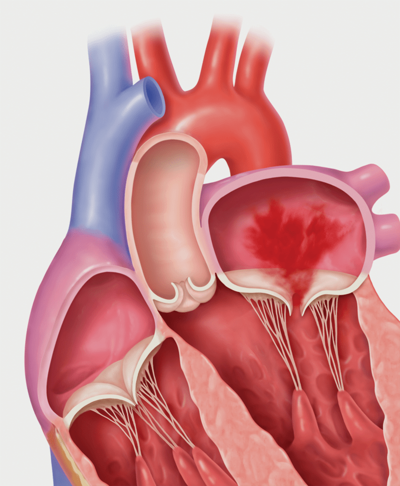 Secondary Mitral Regrugitation