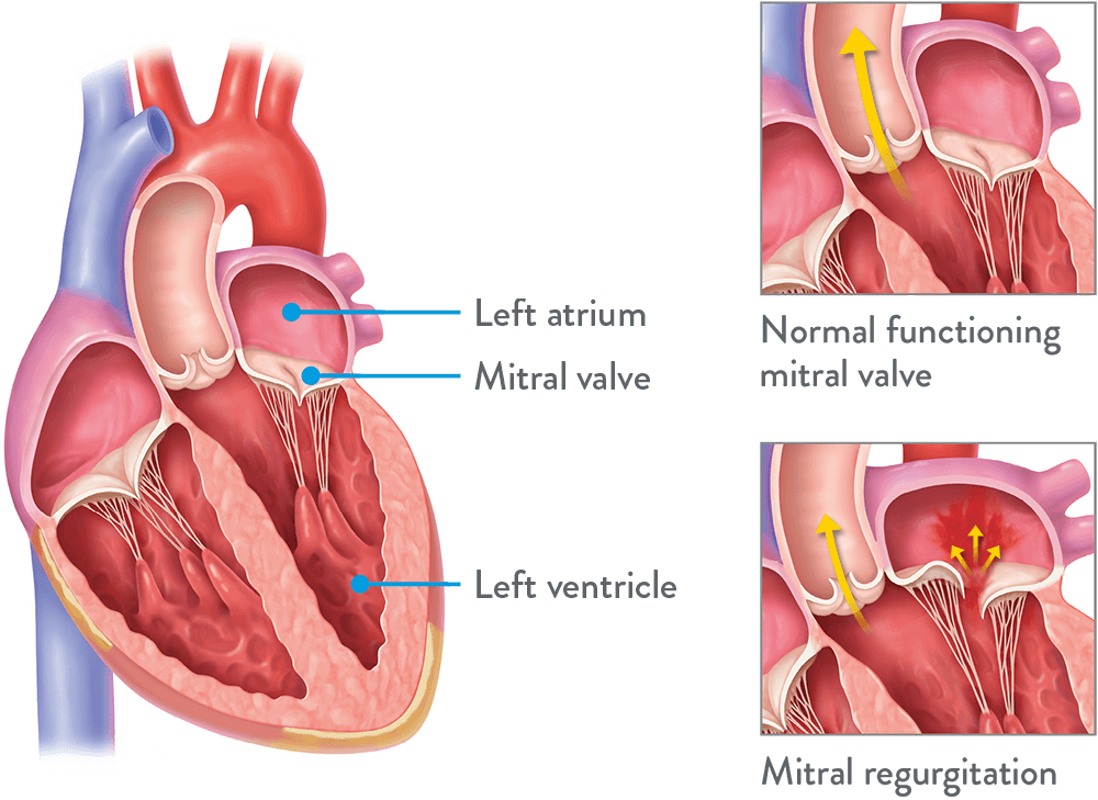 Mitral Regurgitation