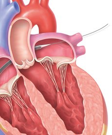 Transcatheter Mitral Valve Repair Step 2