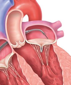 Transcatheter Mitral Valve Repair Step 4