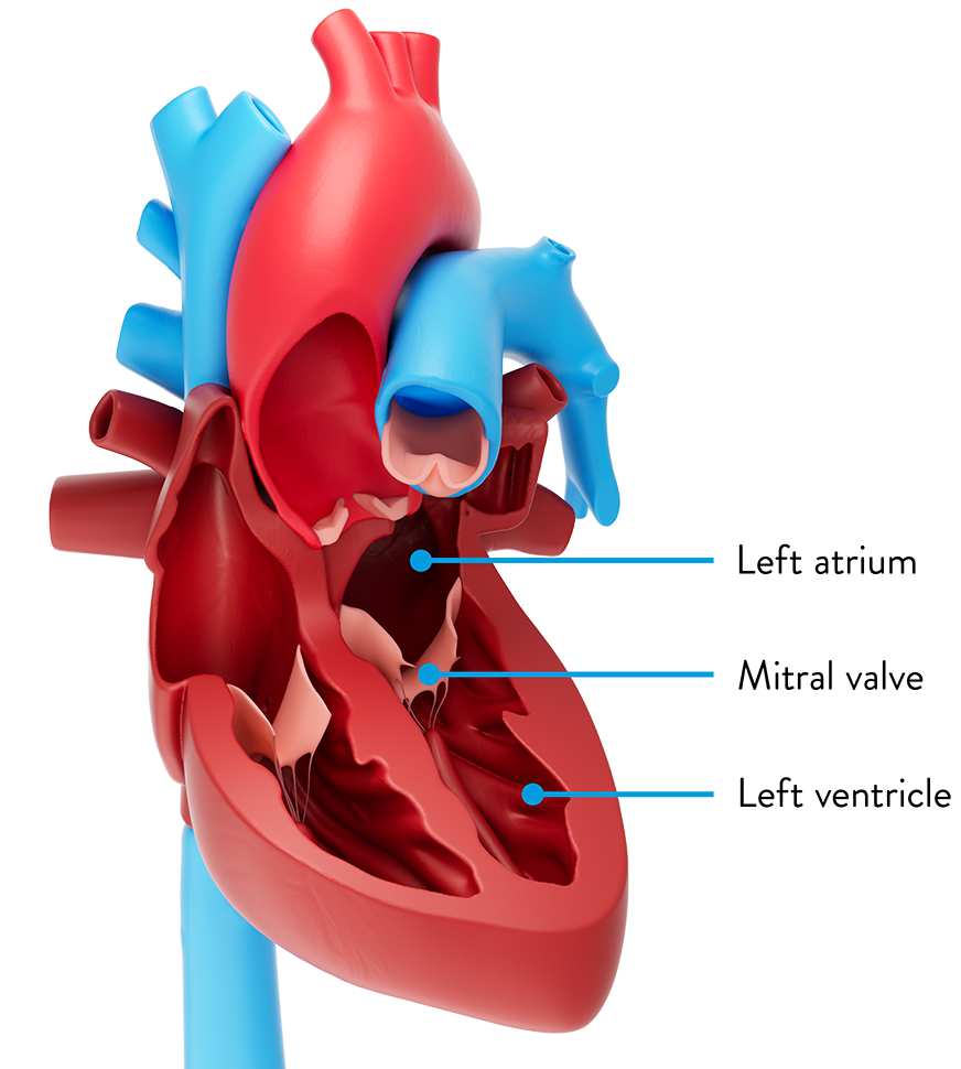 Mitral Regurgitation