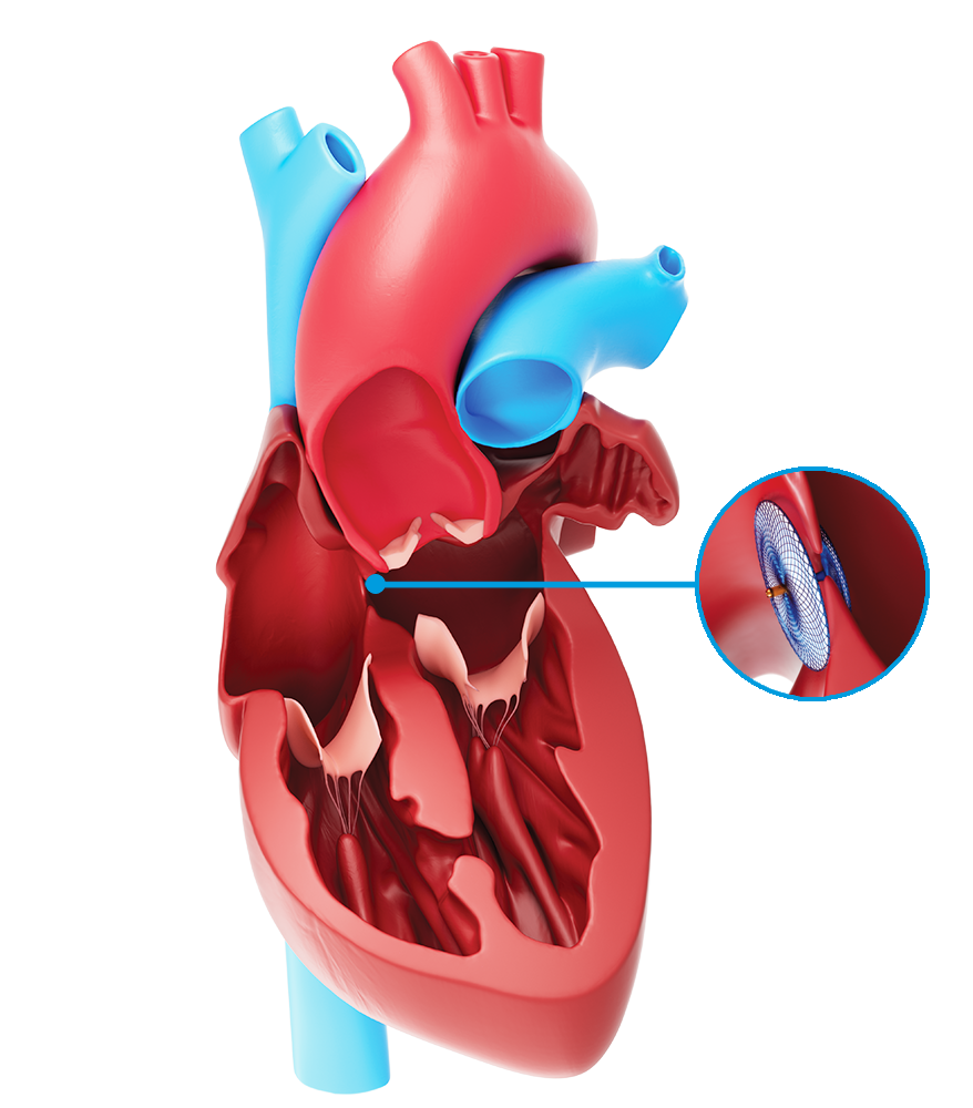 PFO Treatment Options