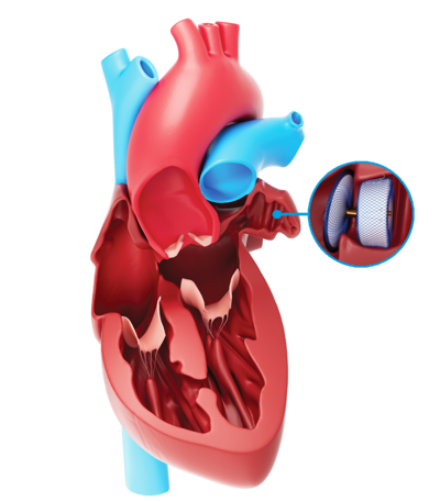 Atrial Fibrilation Treatment