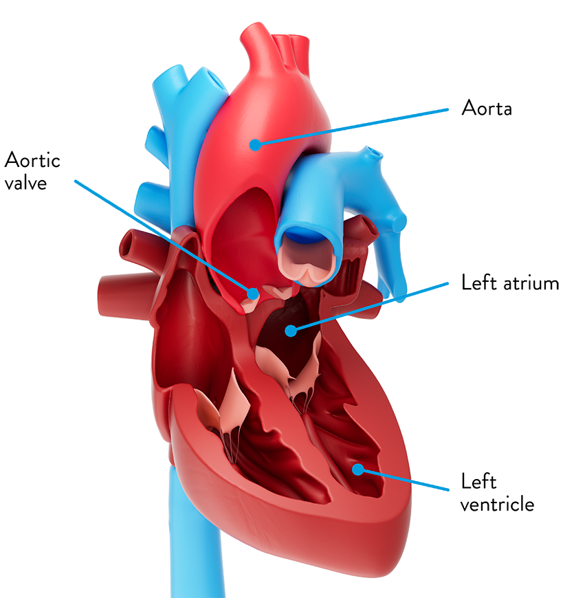 Aortic Stenosis Aortic Valve