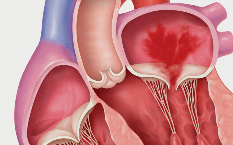 Secondary Mitral Regurgitation