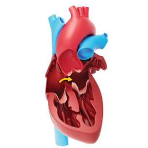 Patent Foramen Ovale Patent Foramen Ovale