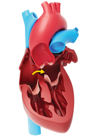 Patent Foramen Ovale