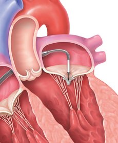 Transcatheter Mitral Valve Repair Step 3