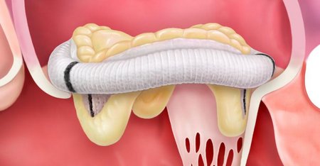 Tissue Valve Tissue Valve