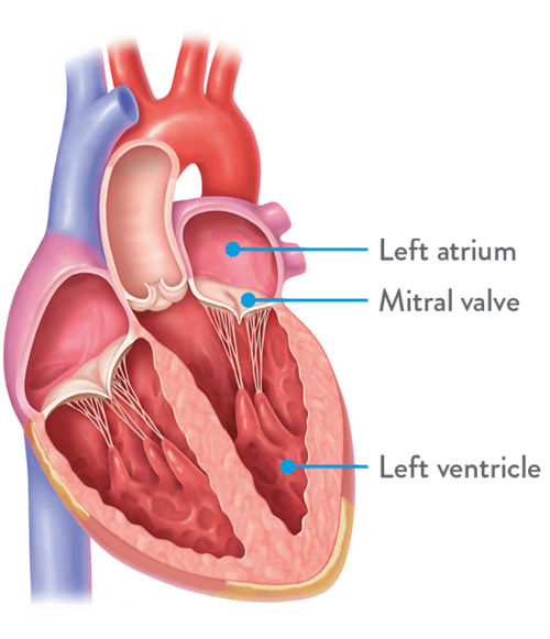 Mitral Regurgitation
