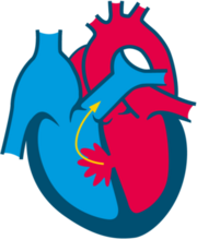 Ventricular Septal Defect Ventricular Septal Defect