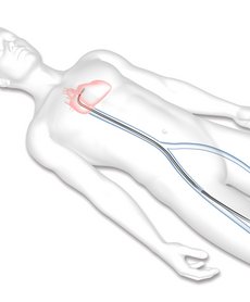 Transcatheter Mitral Valve Repair Step 1